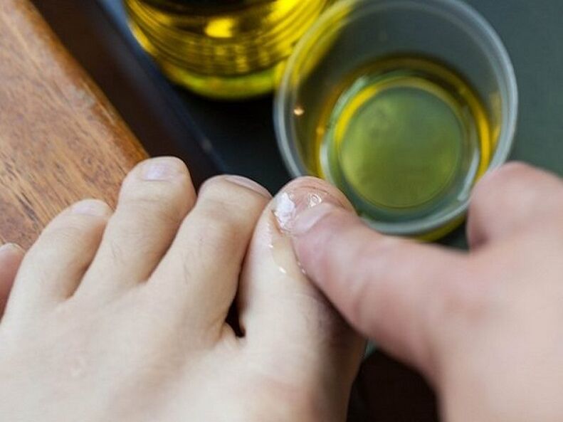 tea tree oil for toenail fungus