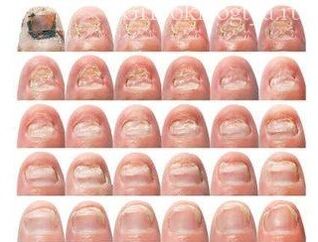 Damage gradually on nails with fungus