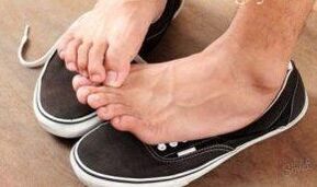 Itching as a source of fungus