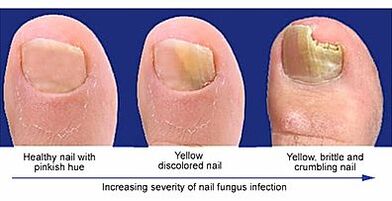 Manifestation of nail fungus