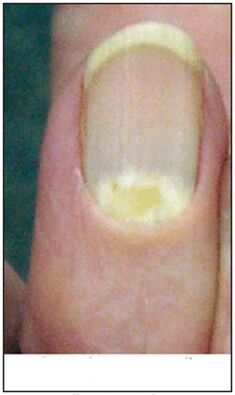 fungus that burns proximal