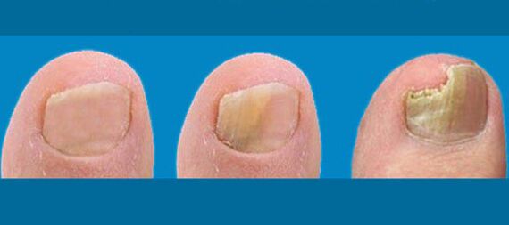 Nail fungus level