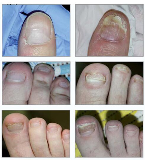 Type of nail fungus