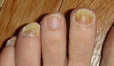 The cause of the appearance of fungus on the nails