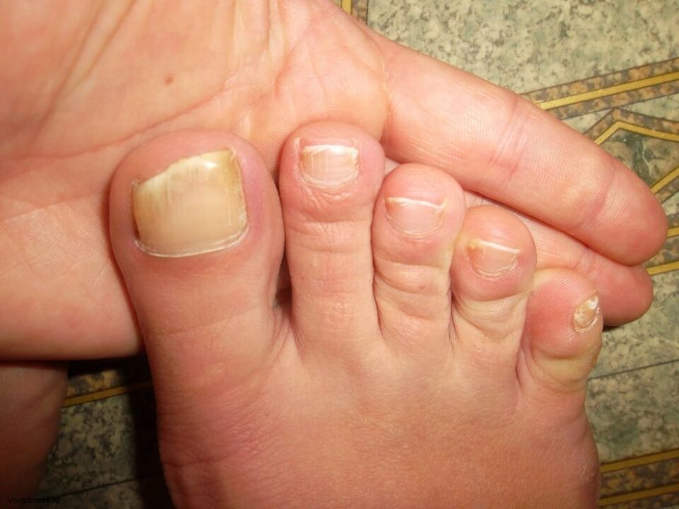 yellowing of nails with fungus