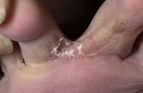 Girbok between fingers