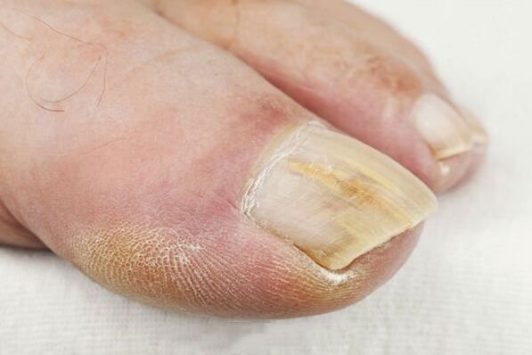 As a result of a fungal lesion
