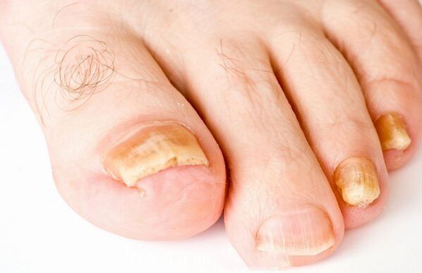 The shape of the nail fungus