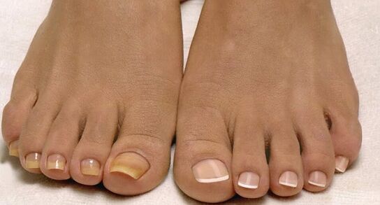 regular nails and toenails fungus