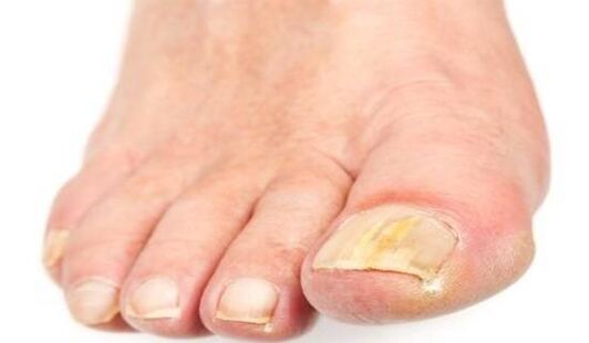 yellow nails due to fungal infection