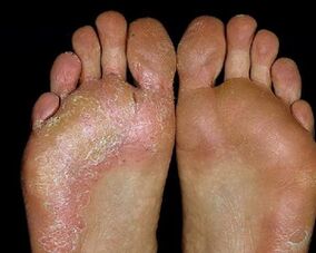 wounds on the feet with fungus
