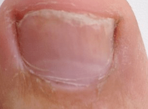 photo of early stages of toenail fungus