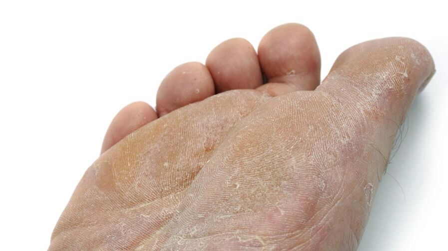 toenail fungus symptoms