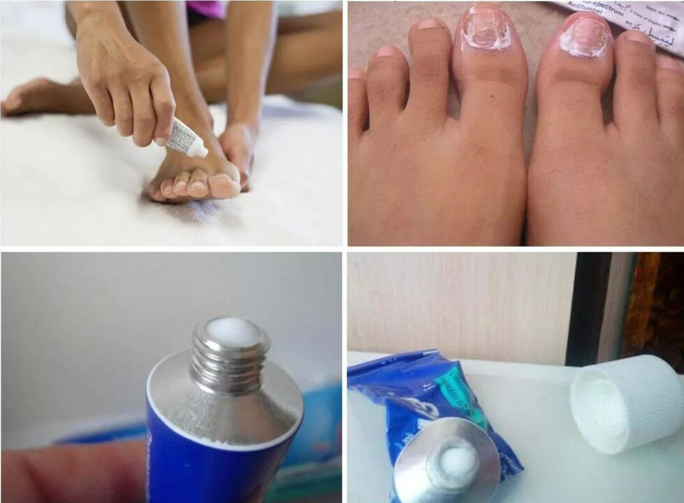 toenail fungus medicine