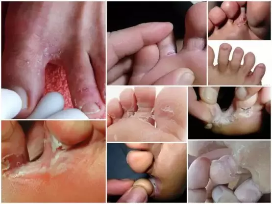 symptoms of fungus between the toes photo 1