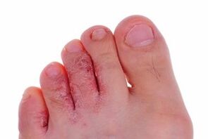 fungal skin lesions on the feet