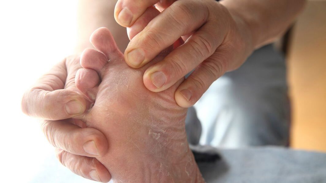 toenail fungus symptoms