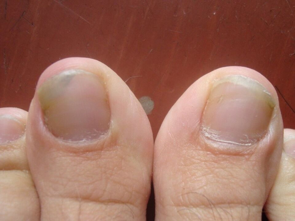 symptoms and causes of nail fungus